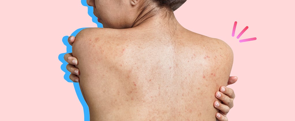 How to Get Rid of Acne Scars and Marks, According to Dermatologists