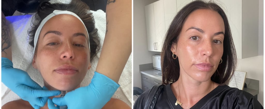 I Tried an Exosome Facial: See Photos