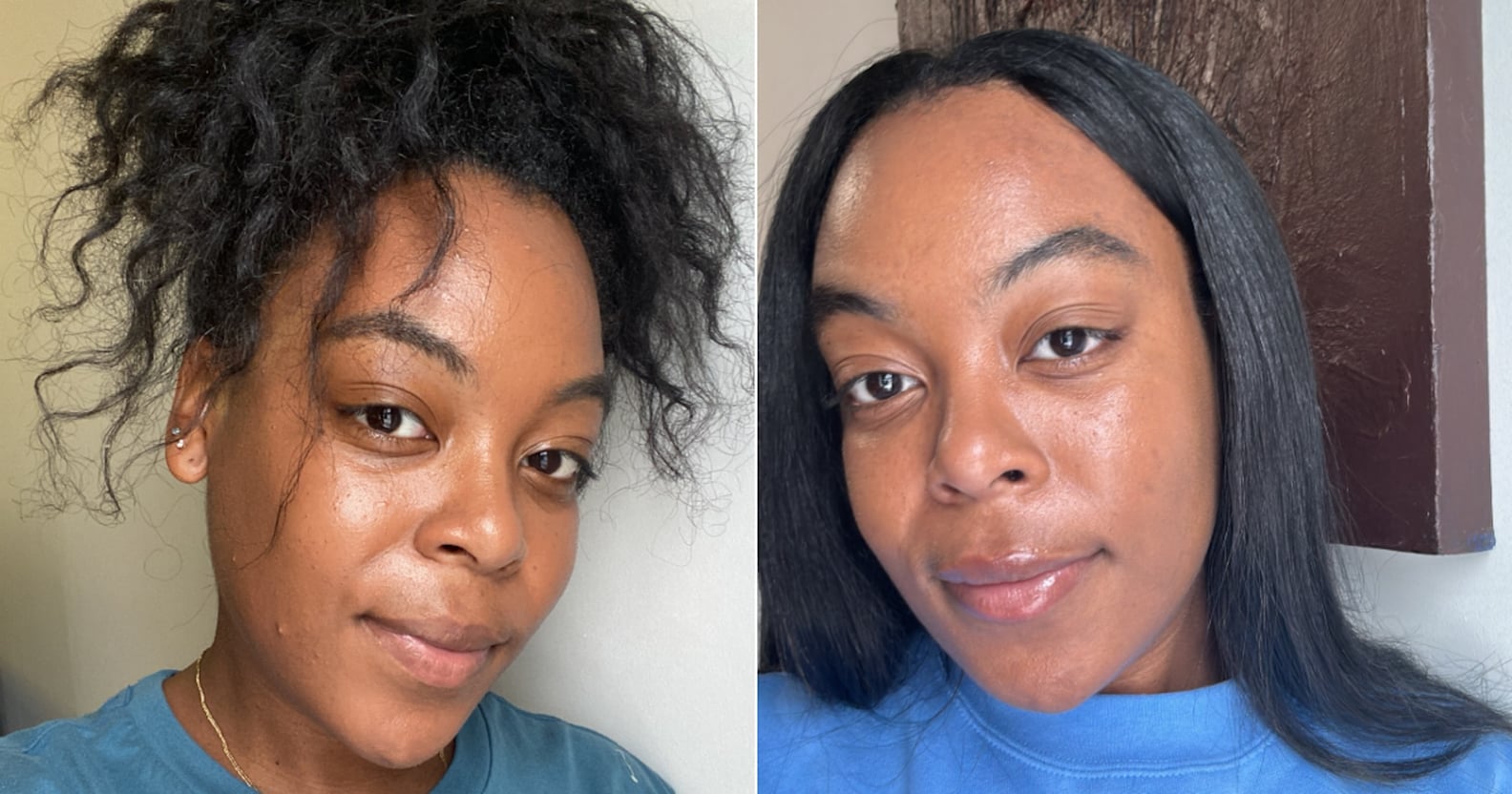 Winlevi Before and After My Experience With the Acne Cream POPSUGAR Beauty