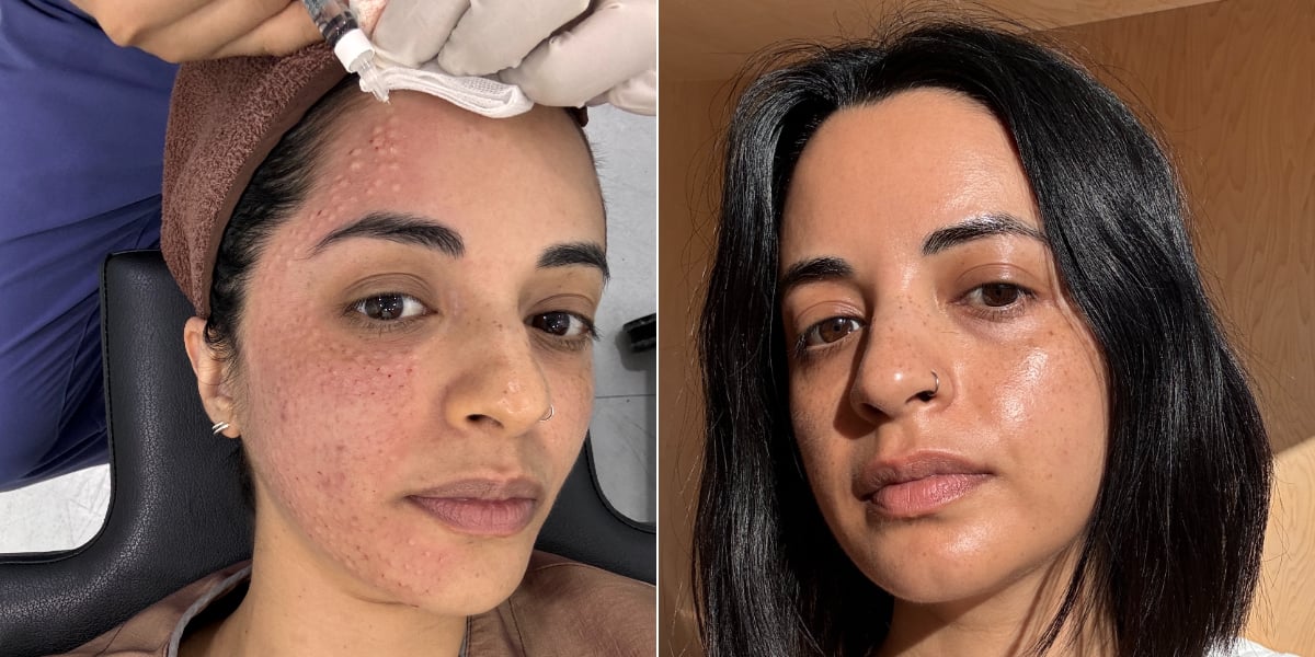 I Tried the Celebrity-Loved Salmon Sperm Facial — Here's My Honest Take