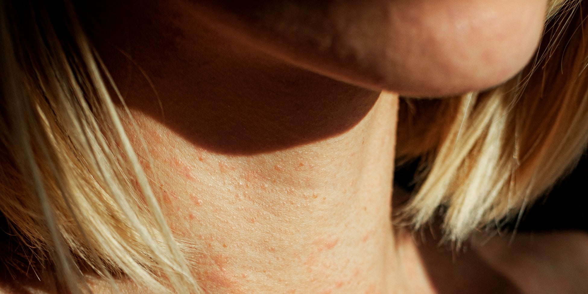 5 Little-Known Tips For Eczema That Actually Work, According to Derms