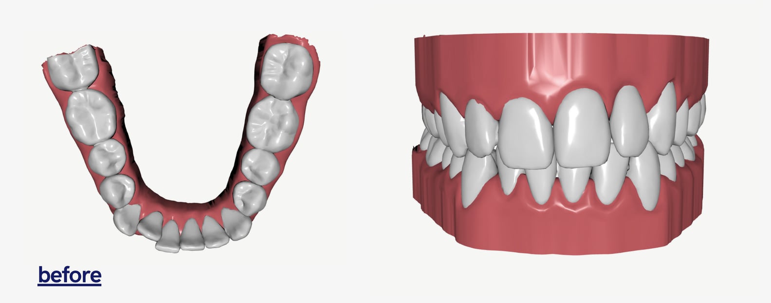 Byte Invisible Aligners Cost and Review | PS Beauty