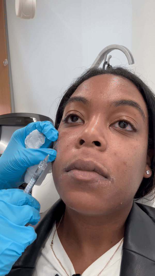Restylane Eyelight