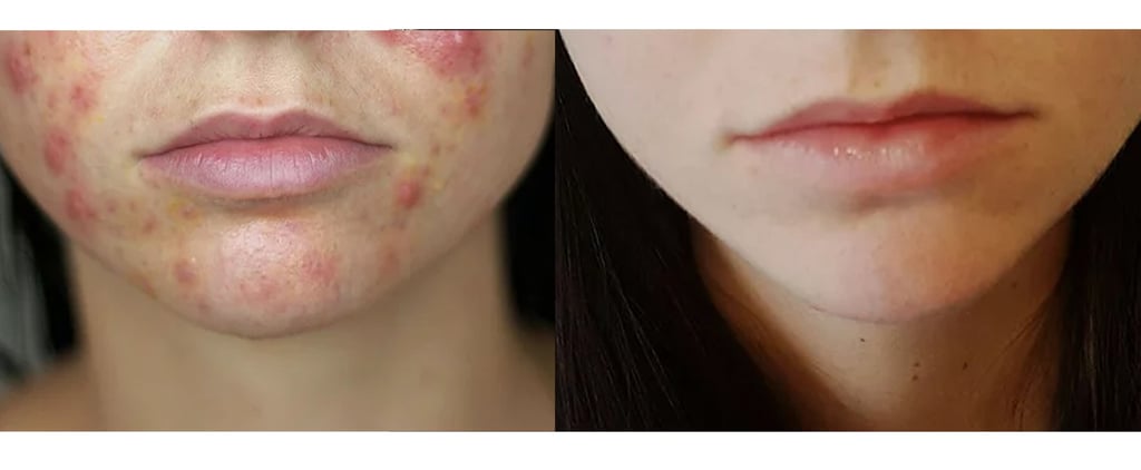 Can You Use Spironolactone to Treat Acne?