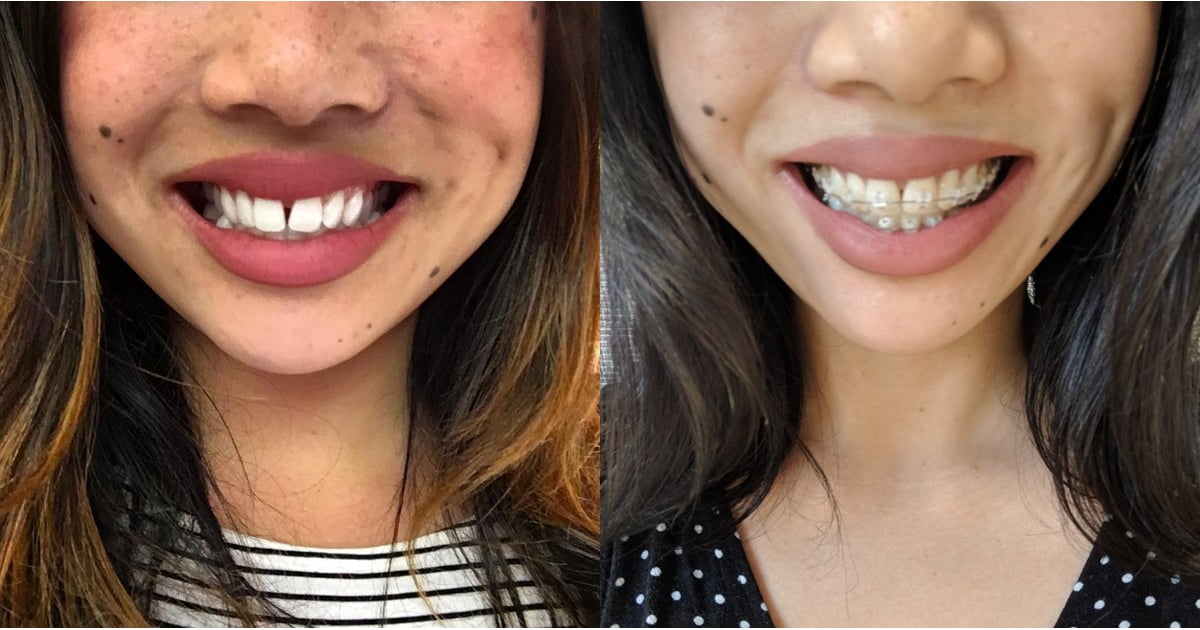 braces before and after gap