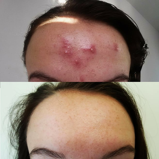 Can You Use Spironolactone To Treat Acne POPSUGAR Beauty UK