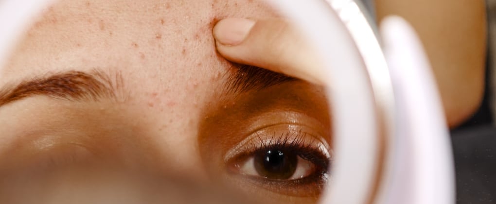 Is That a Pimple or an Ingrown Hair? Here's the Difference