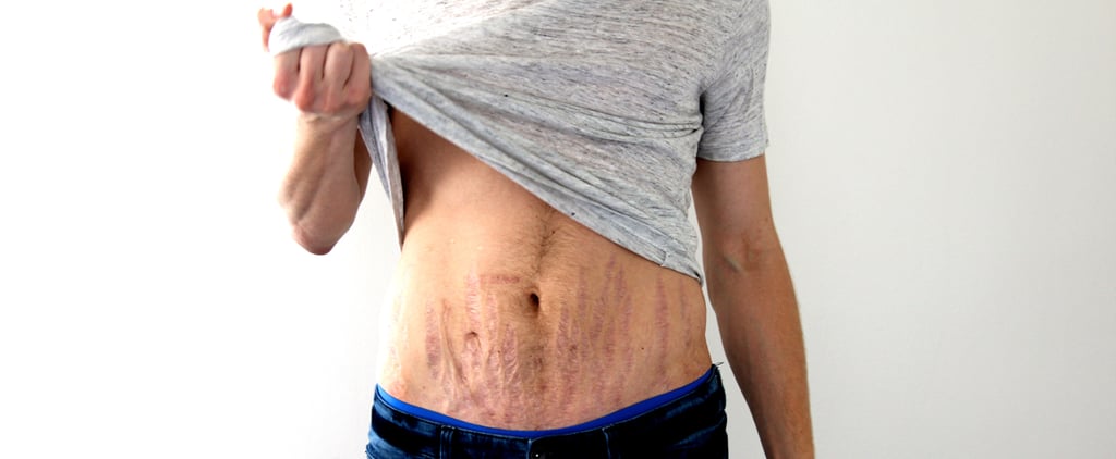 How to Love Your Stretch Marks