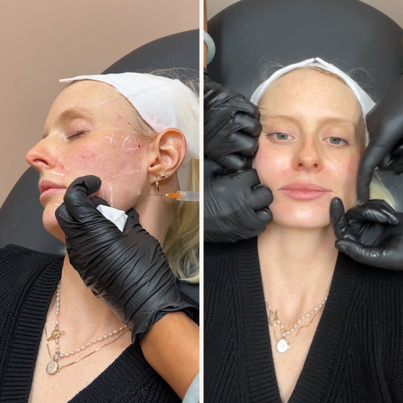 Sculptra injections and facial massage afterward