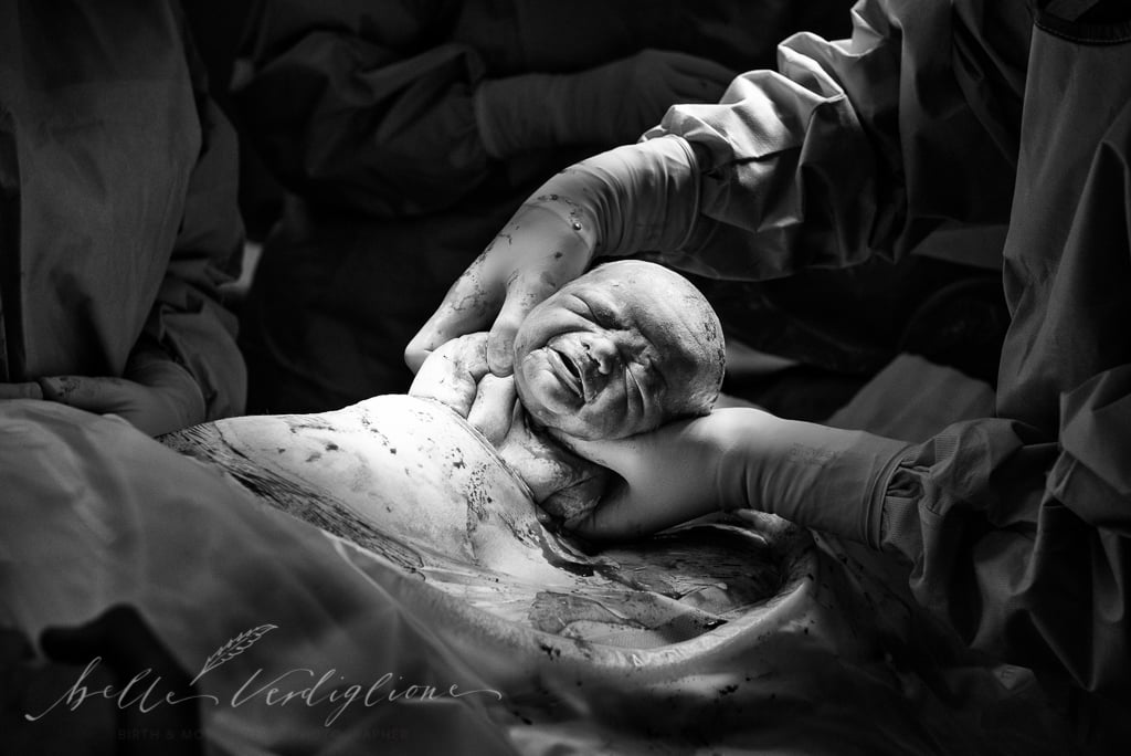C-Section Mom Watching Baby's Birth