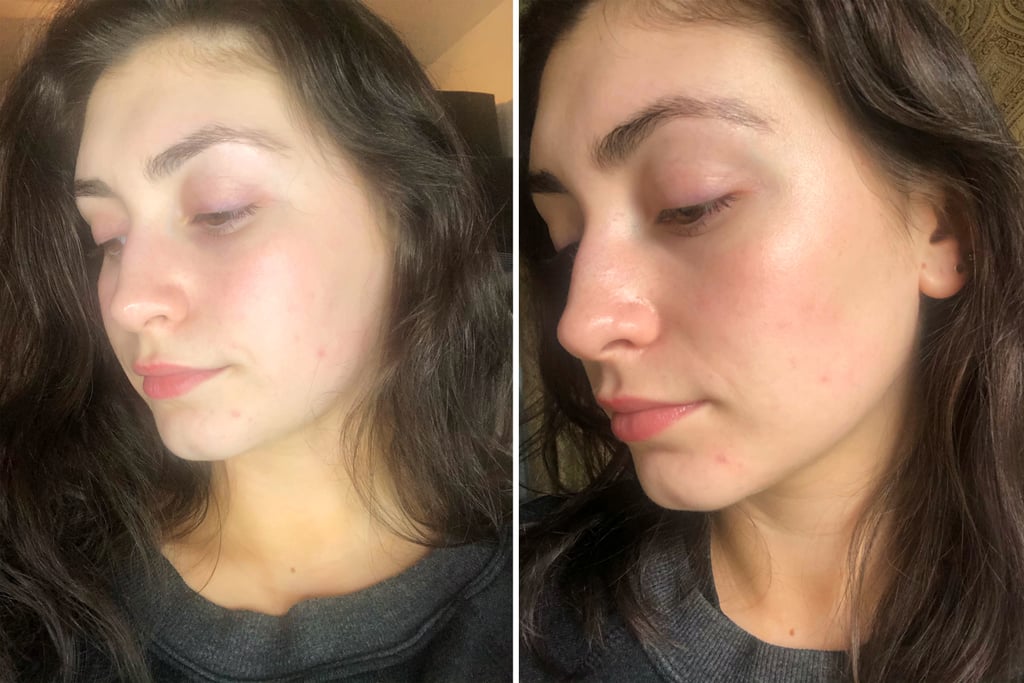 Before and After Using SLMD Dark Spot Fix For 2 Days