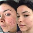 Here's How Bekah From The Bachelor Turned Around Her Severe Acne