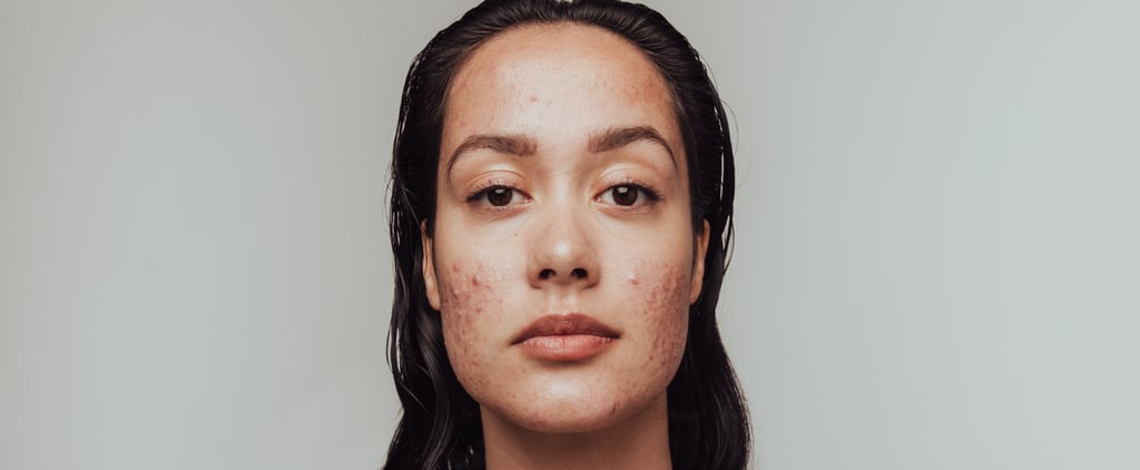 What Is Cortisol Face? Doctors Explain the TikTok Trend