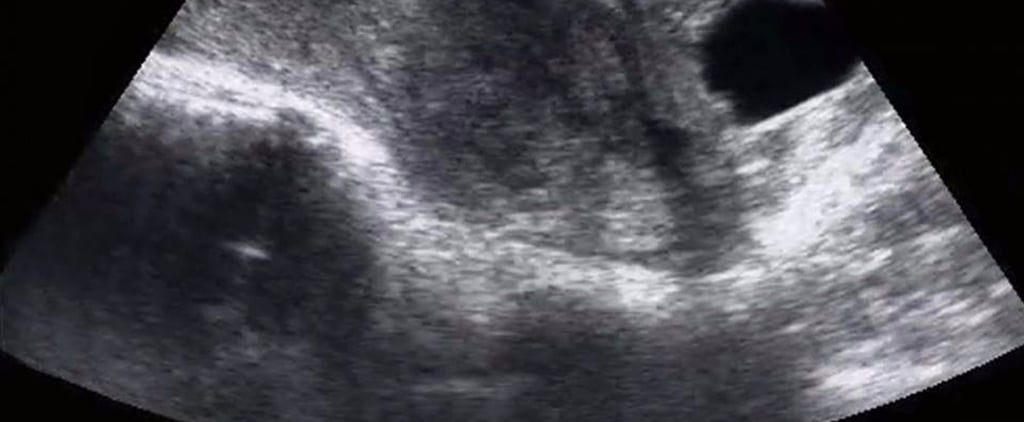 Woman Describes the Emotions That Come With Miscarriage