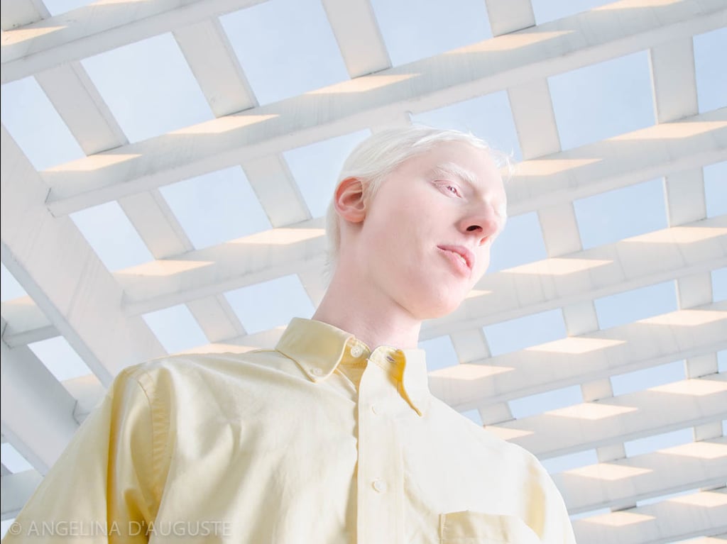 Albinism Photographs