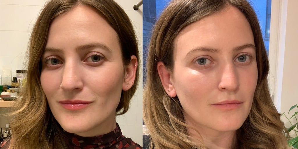 Wrinkles under eyes store before and after