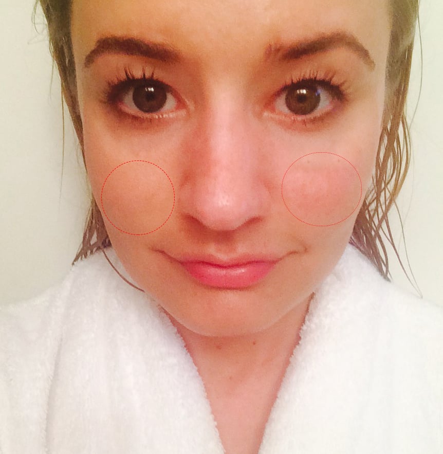 After Shower Selfie Melasma Treatment Popsugar Beauty Photo 2 5729