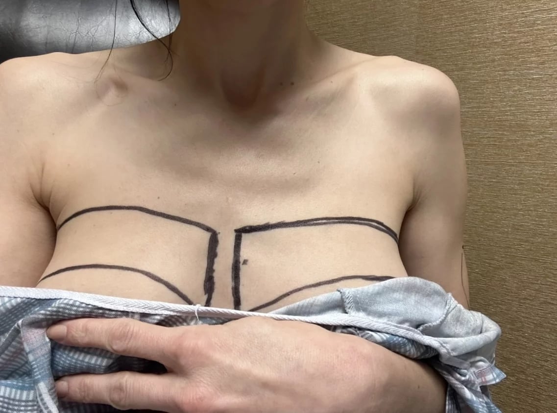 Premium Photo  Female breast comparison before and after breast asymmetry  correction surgery