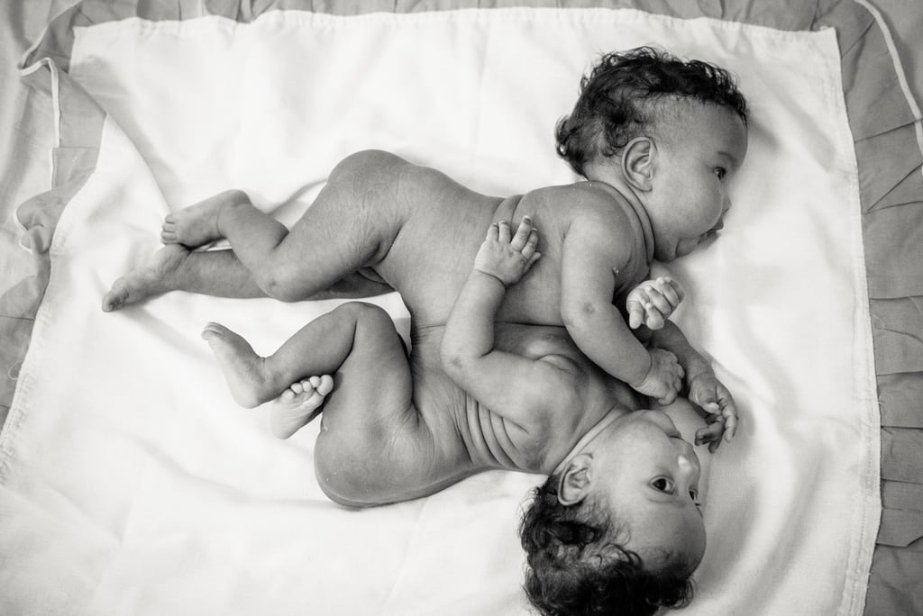 Photographer Captures the Beauty of Conjoined Twins