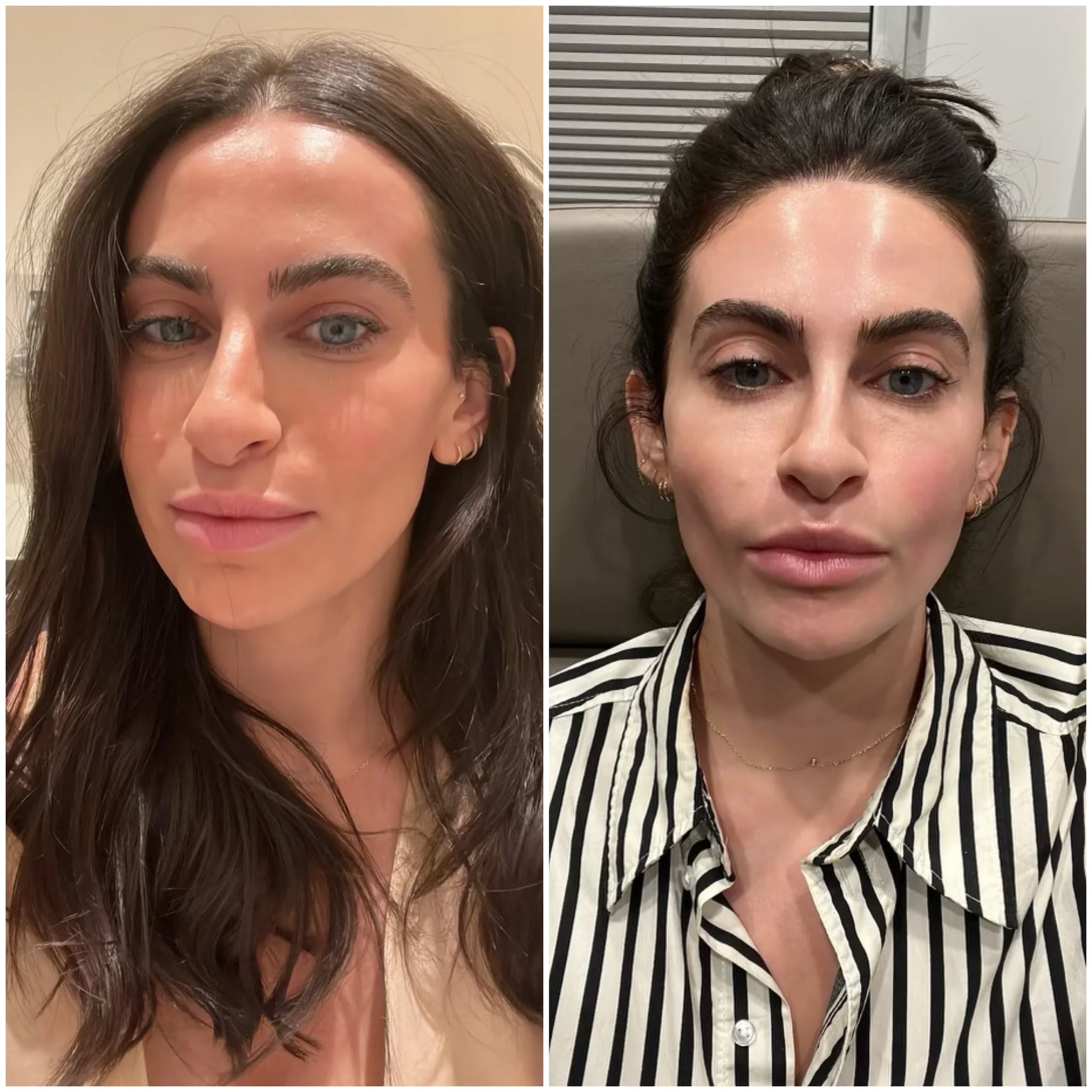 Before and after lip tenting technique