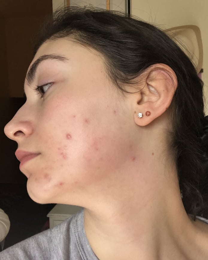 My Personal Journey Taking Spironolactone For Acne Popsugar Beauty