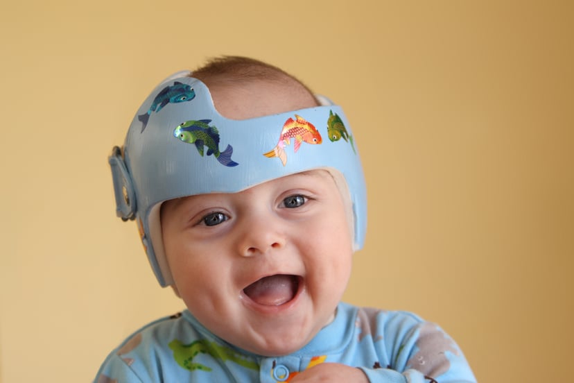Infant wearing a helmet or band for treatment of plagiocephaly (Shallow depth of field. Focus on child's eyes.)SEE ALSO: