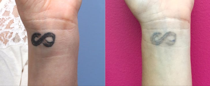 What It's Like to Have a Tattoo Removed | POPSUGAR Beauty