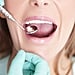 What Is Silver Diamine Fluoride Cavity Treatment?