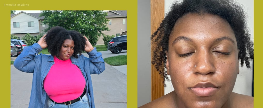 What It's Like to Live With Chronic Spontaneous Urticaria