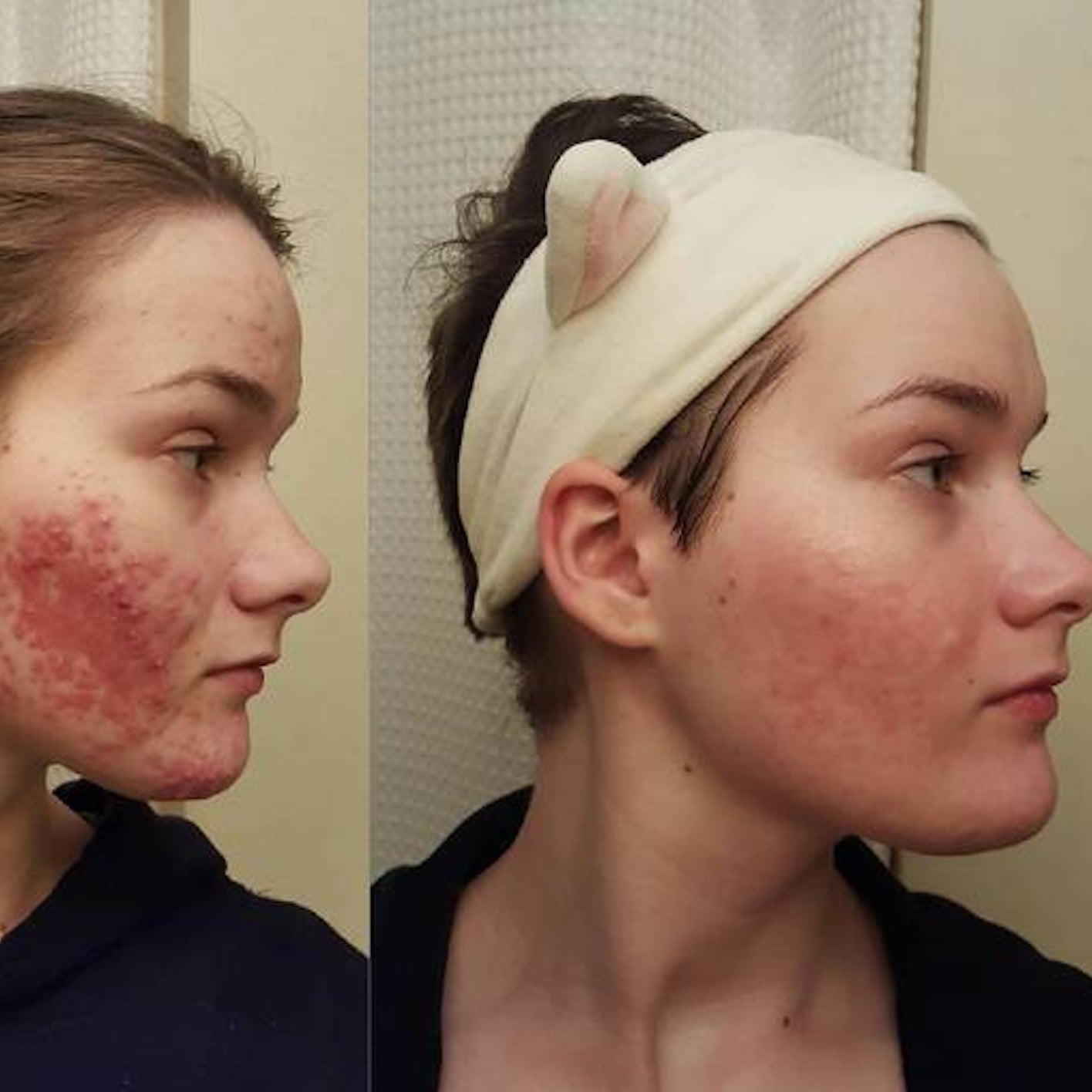 Isotretinoin Tablets Free E newsletter