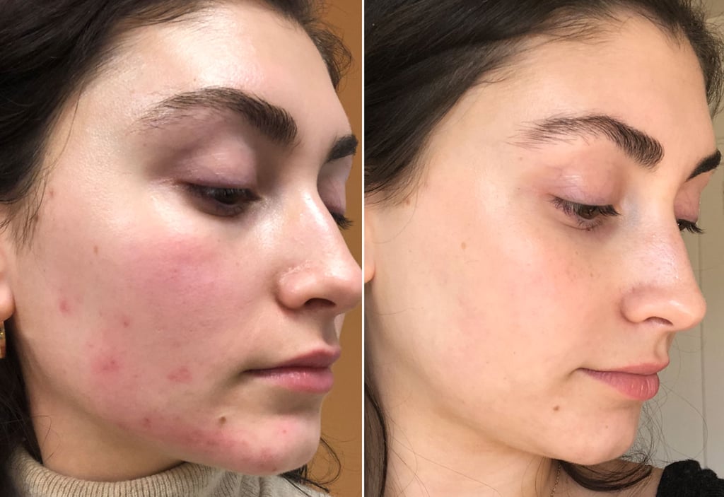 My Skin Right After Treatment vs One Month Later