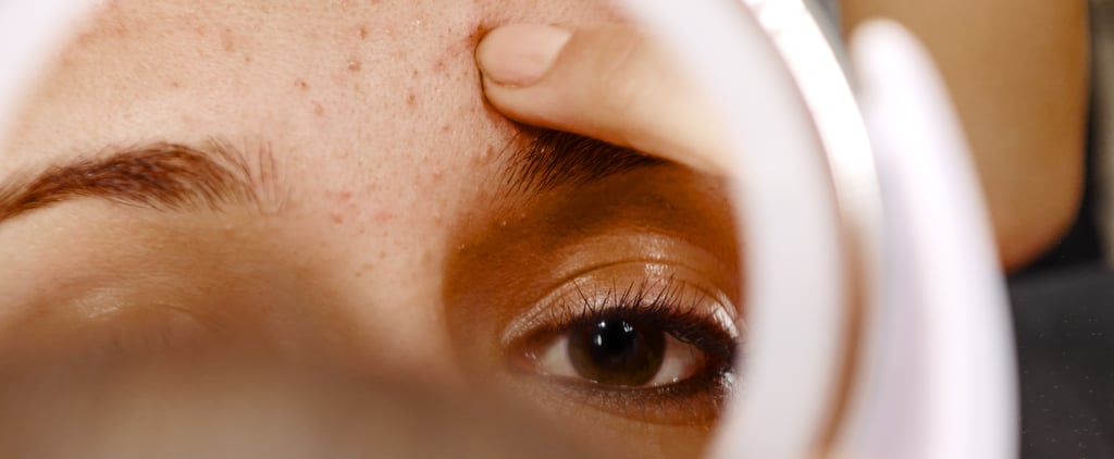 What Is Papulopustular Acne Rosacea and How to Treat It