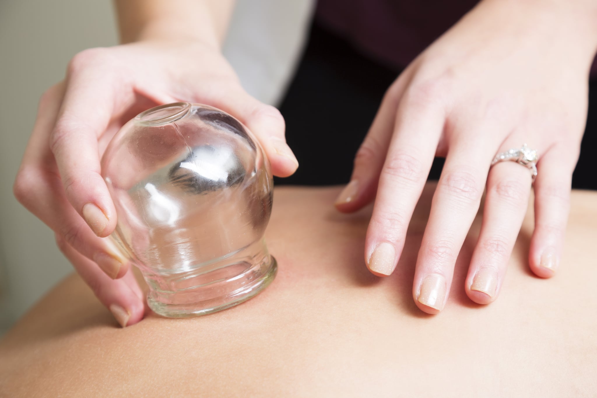 An acupuncturist uses the ancient technique of vacuum cupping on a patient's back. You might also be interested in these: