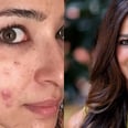 This Dermatologist Took a Photo of Her Acne For an Important Reason