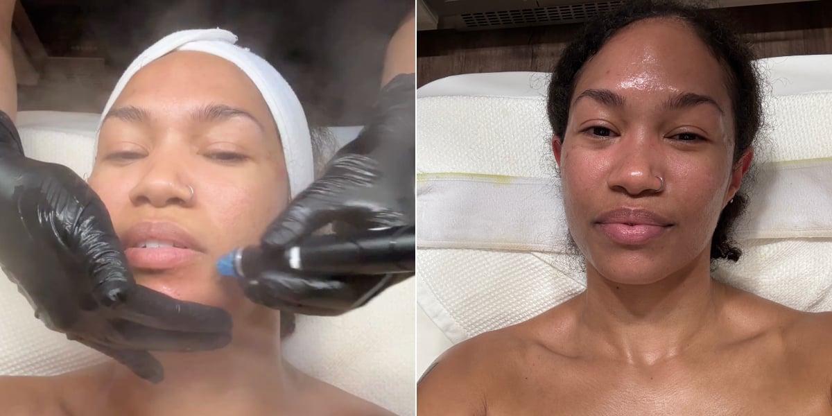 I Tried a "Gunk Facial," and It Was So Good For My Acne-Prone Skin