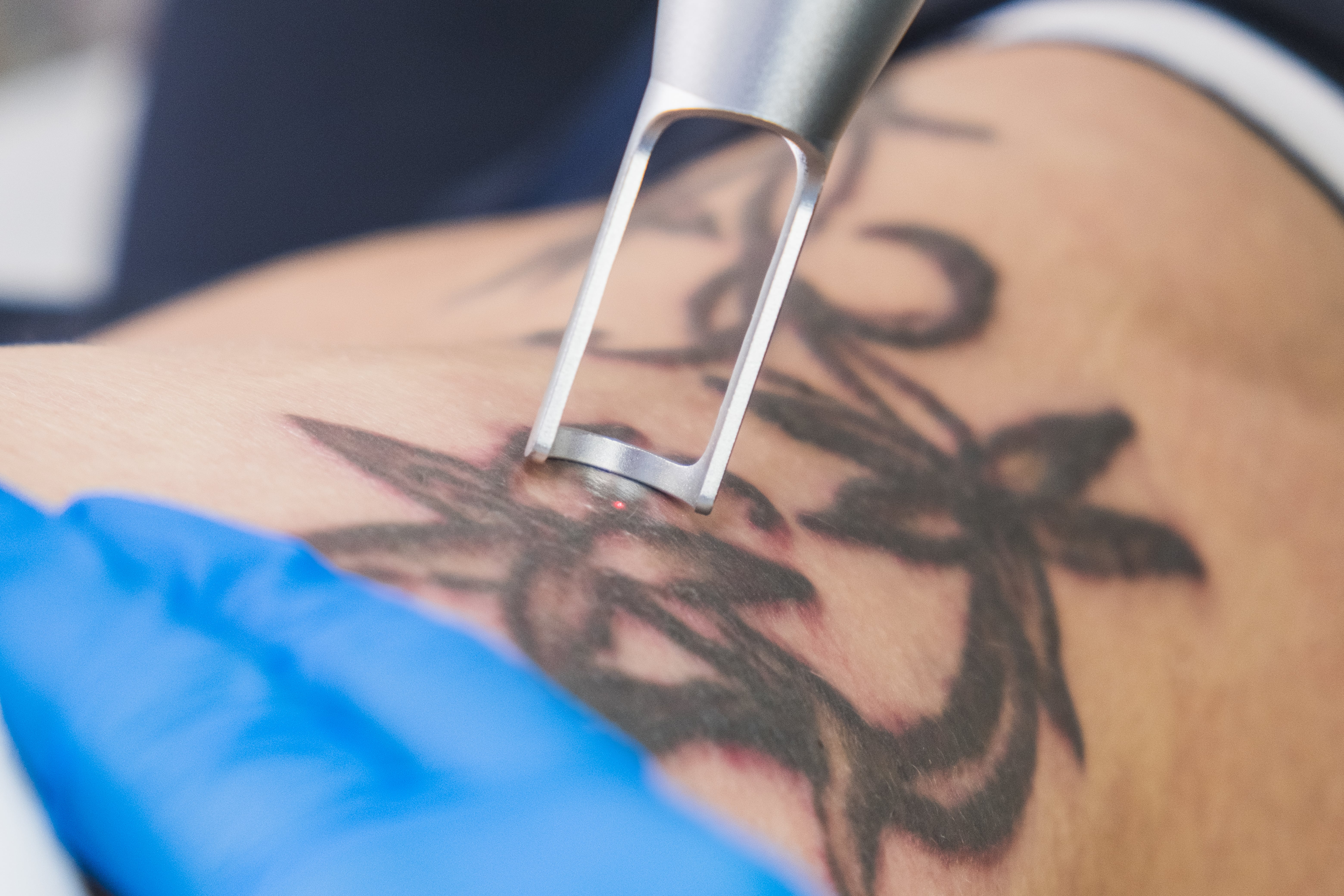 Does Tattoo Removal Hurt? Here’s the Straight Answer