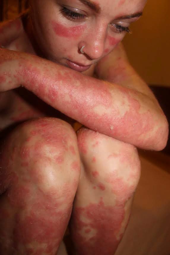 Model With Psoriasis | Psoriasis Pictures