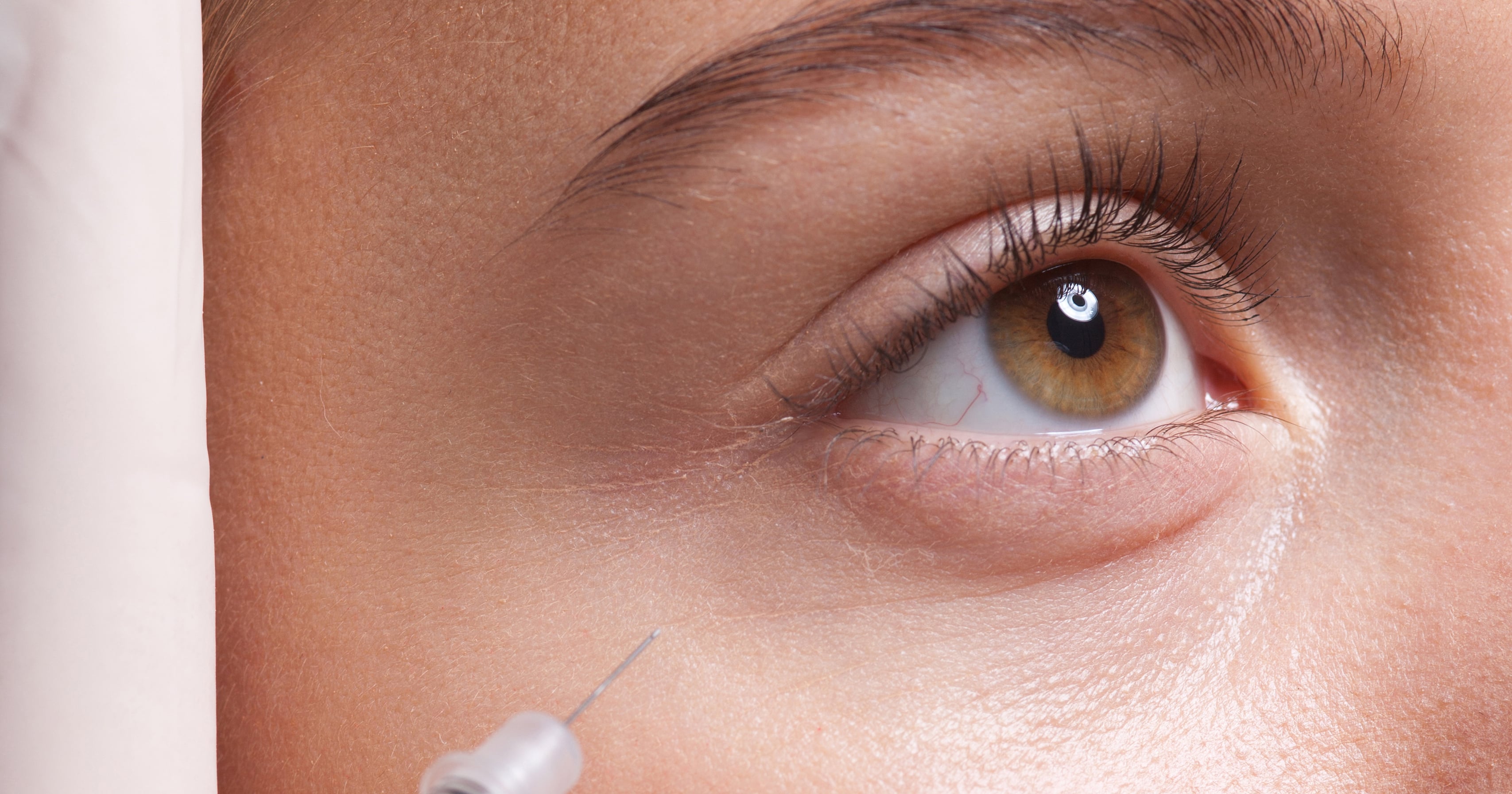 What Is Restylane Eyelight Undereye Filler? POPSUGAR Beauty