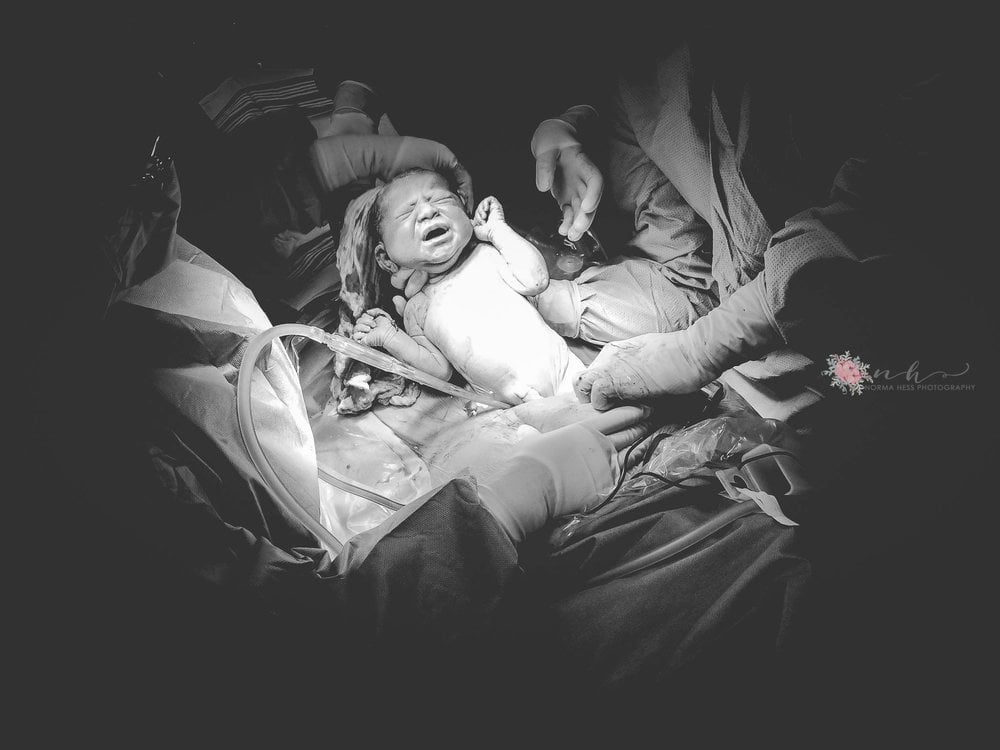 C-Section Birth Photography