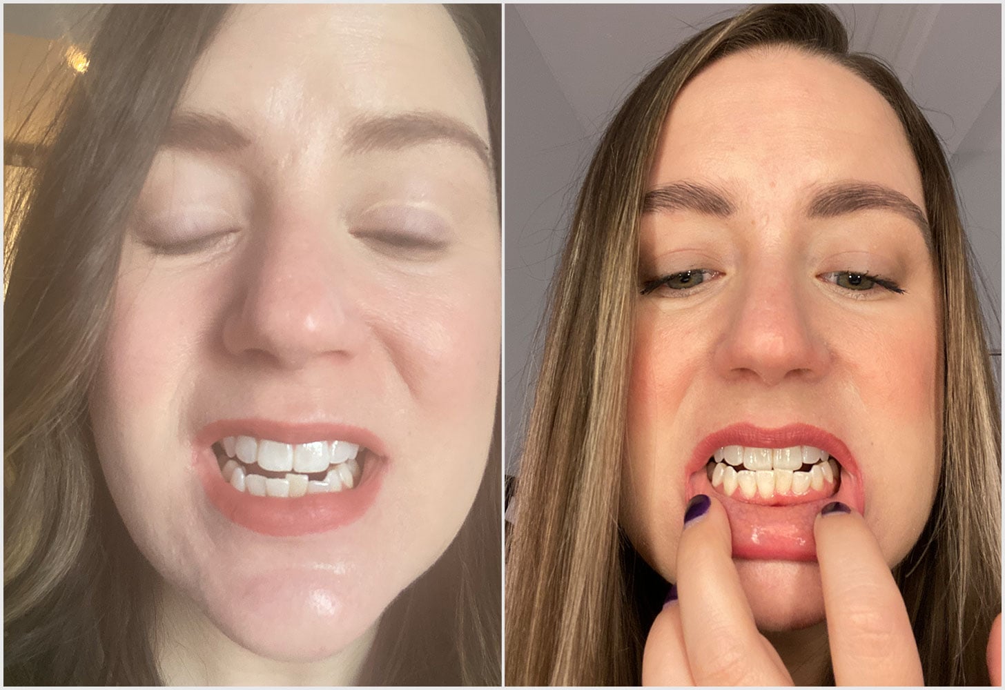 Smile Direct Club Teeth Aligners Review and Photos | POPSUGAR Beauty