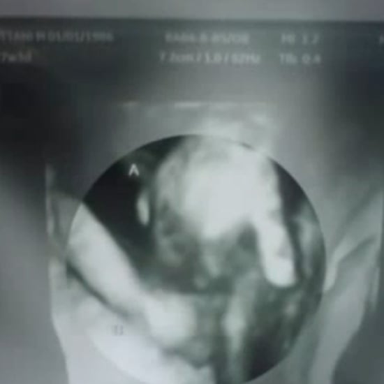 Sonogram Shows Twins Holding Hands