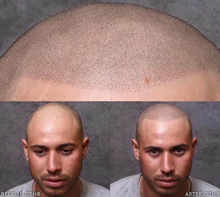 Top Questions Answered About Scalp Micropigmentation  SMP