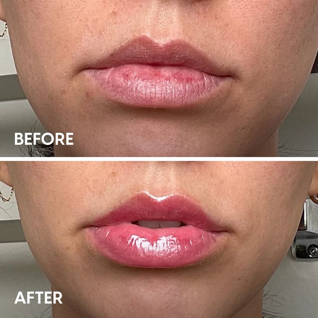Best Luxury Lip Plumper