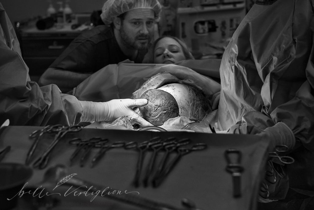 C-Section Mom Watching Baby's Birth