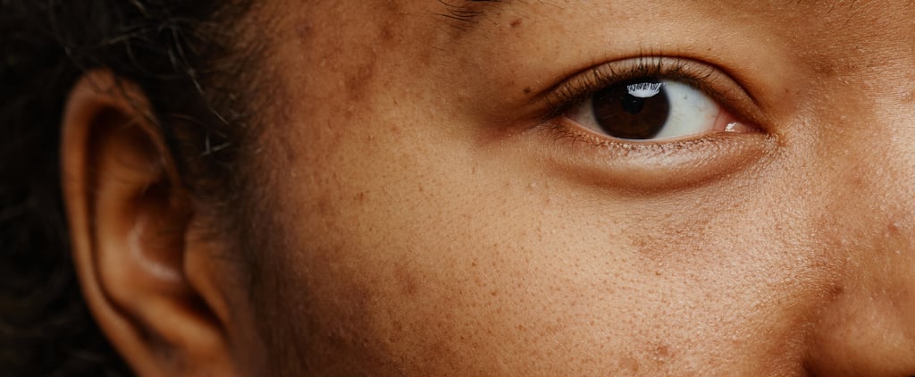 6 Types of Acne: Take Our Quiz to Identify Them