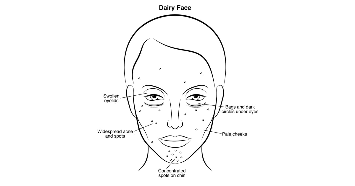 Dairy Face Gut Health and Skin Problems POPSUGAR Beauty Photo 1