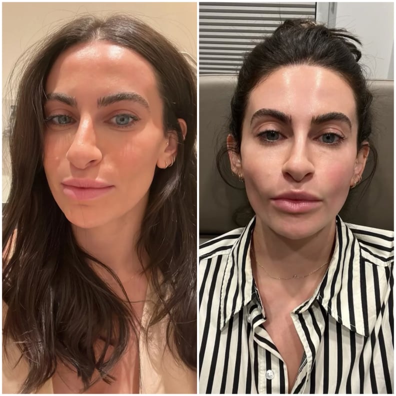 Before and after lip tenting technique