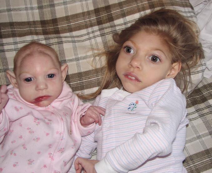 Accutane Birth Defects