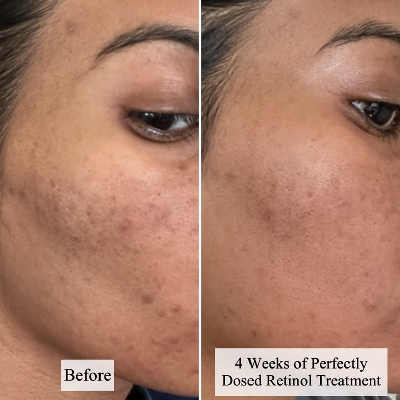 Results of woman using the Dr. Dennis Gross Skincare Advanced Retinol + Ferulic Perfectly Dosed Retinol Treatment for four weeks.
