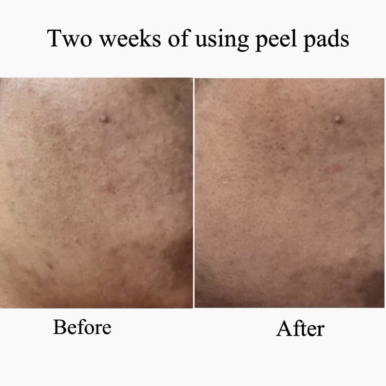 My Results Using Dr. Dennis Gross Skincare Advanced Retinol + Ferulic Overnight Texture Renewal Peel